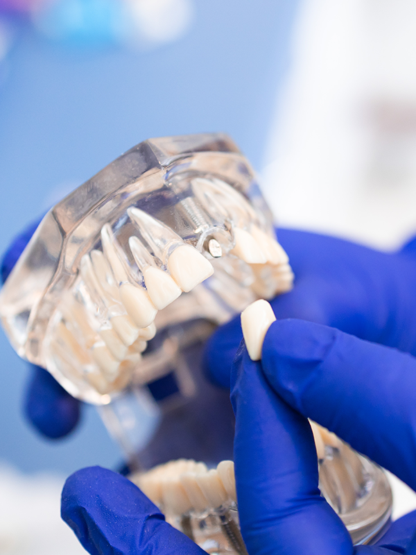 Dental Crowns Woodbridge VA