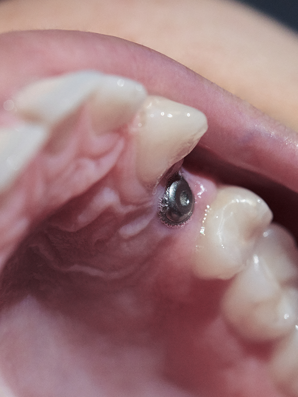 Dental Implants Woodbridge VA