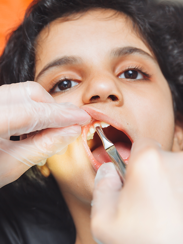 Tooth Extraction Woodbridge VA