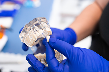 small-dental-crowns