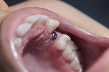 small-dental-implants