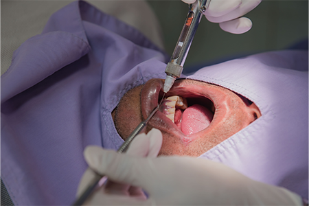 small-periodontics