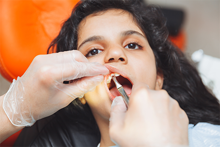 small-tooth-extractions
